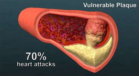 vulnerable plaque 3-D model