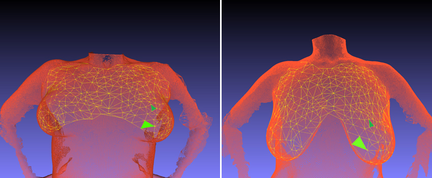 breast reconstruction image